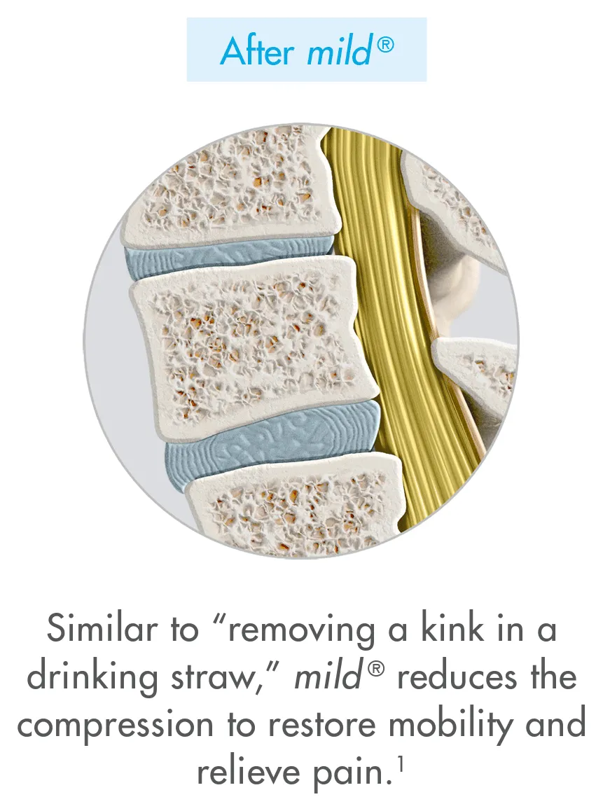 After mild®: illustration of the lower spine with the excess ligament reduced. Similar to “removing a kink in a drinking straw,” mild® reduces the compression to restore mobility and relieve pain