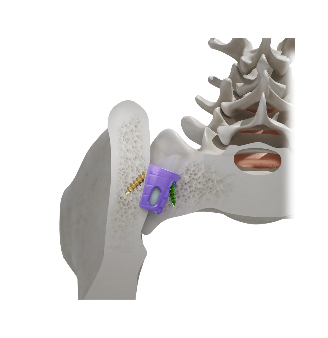 Cutaway illustration of the SiLO TFX system spanning the sacrum and ilium