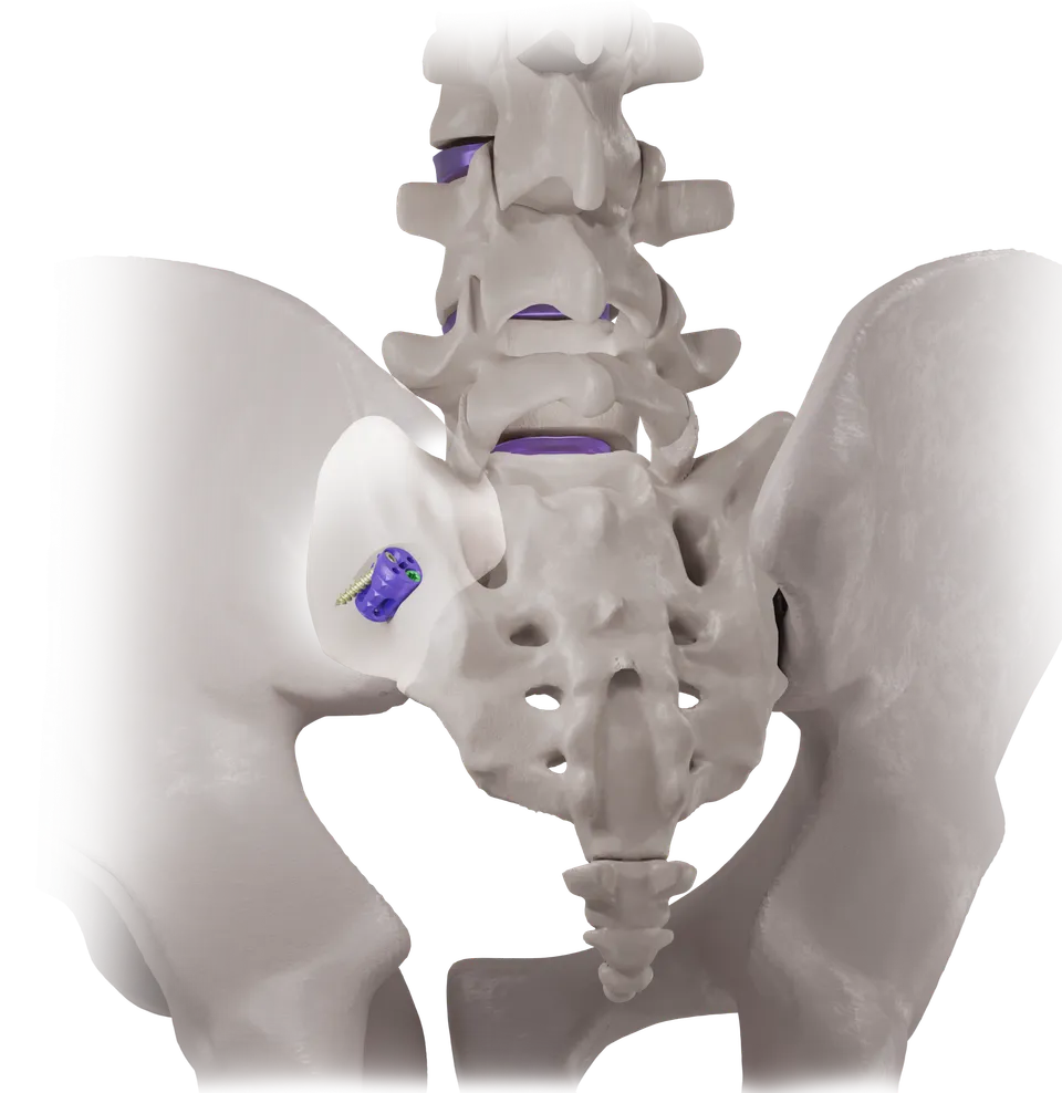 Pelvis showing the SiLO TFX implant at the sacroiliac joint