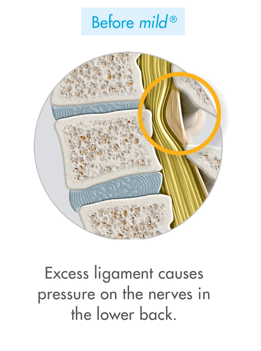 Before mild®: illustration of the lower spine in which excess ligament causes pressure on the nerves in the lower back