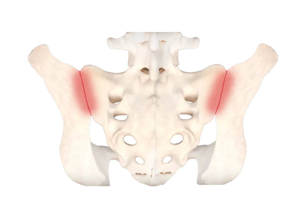 Illustration of an inflamed sacroiliac joint