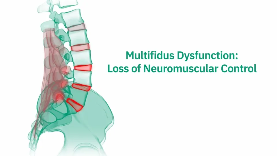 Illustration of multifidus dysfunction