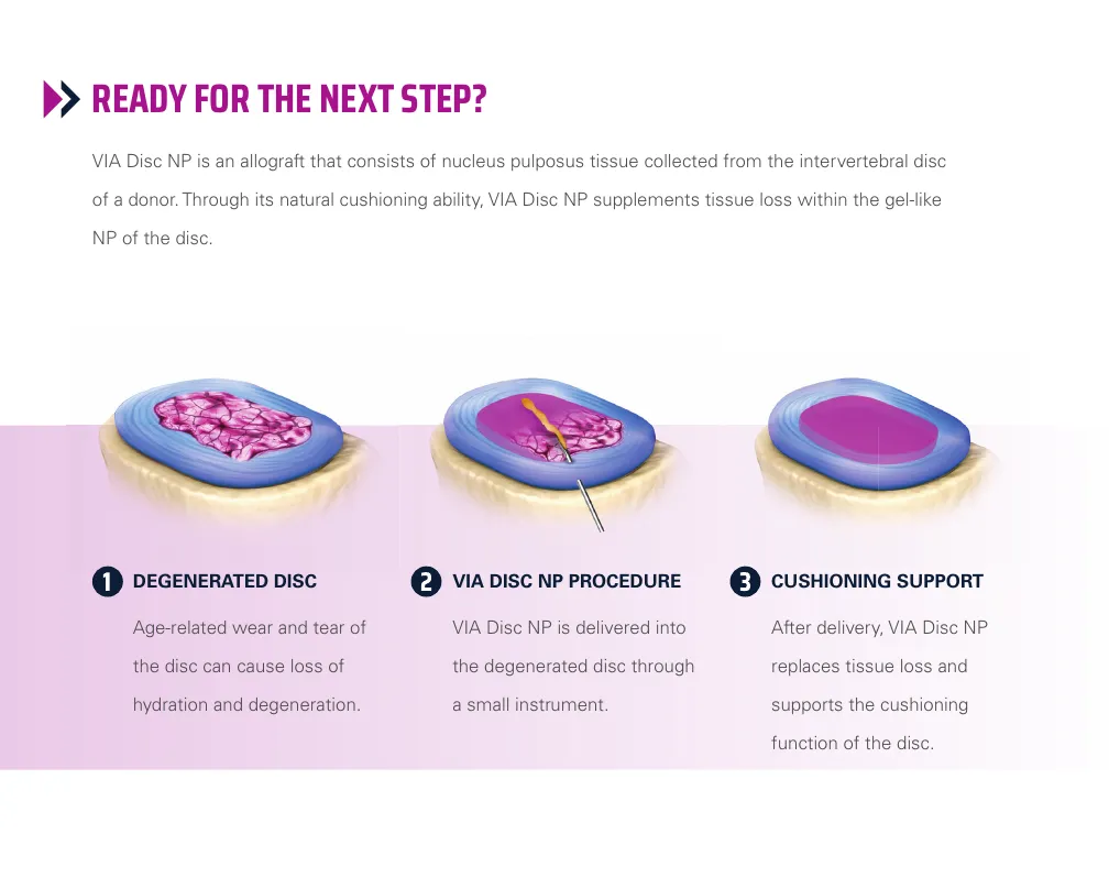 Three-step illustration showing a degenerated disc, VIA Disc NP delivery, and cushioning support
