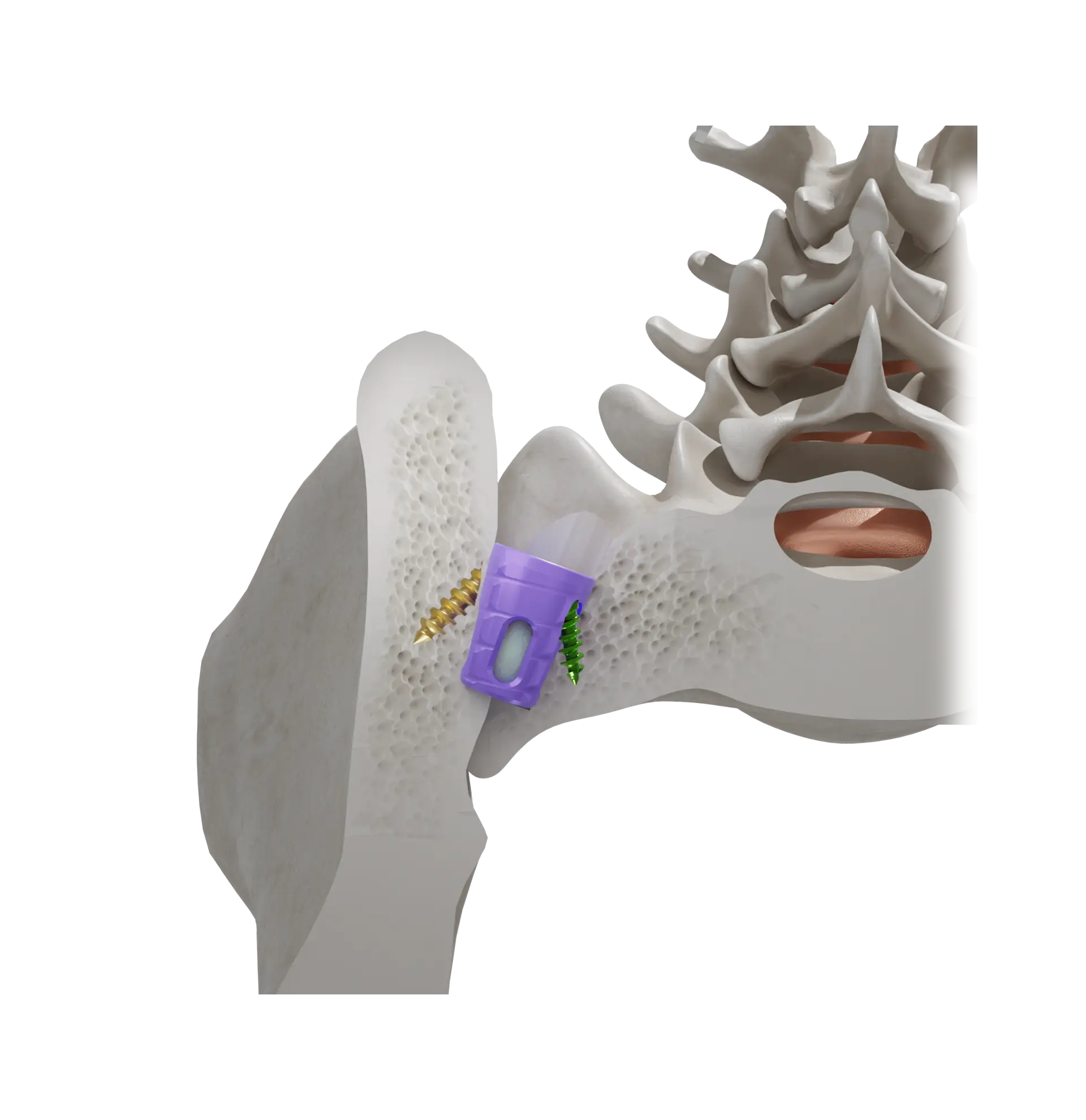 Cutaway illustration of the SiLO TFX system spanning the sacrum and ilium