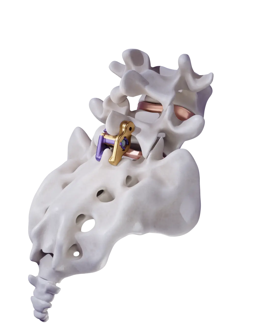 ZIP 51 implant designed for L5-S1 fusion