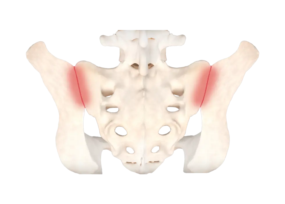 Illustration of an inflamed sacroiliac joint