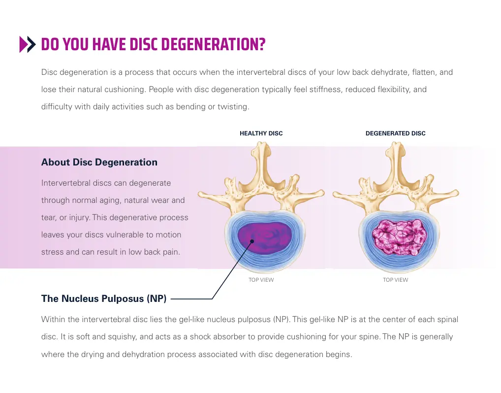 Illustration comparing a healthy intervertebral disc with a degenerated disc