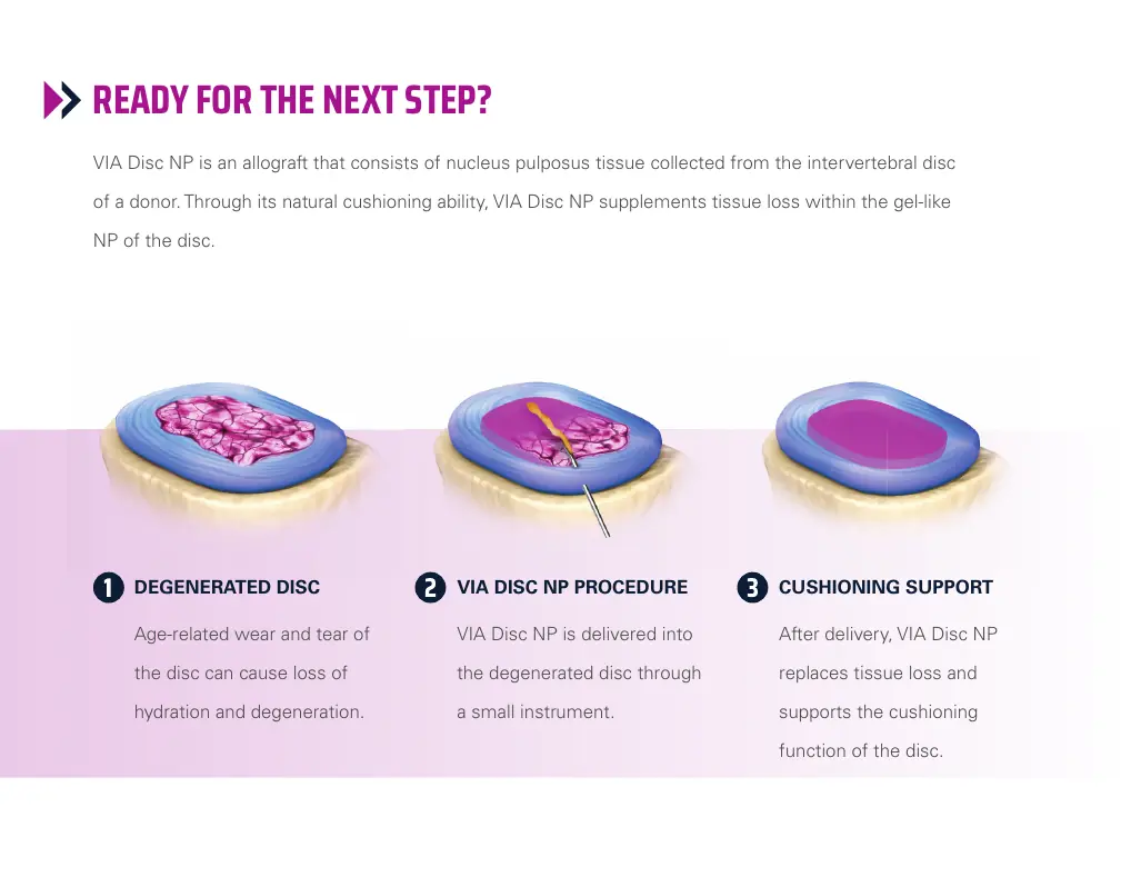 Three-step illustration showing a degenerated disc, VIA Disc NP delivery, and cushioning support