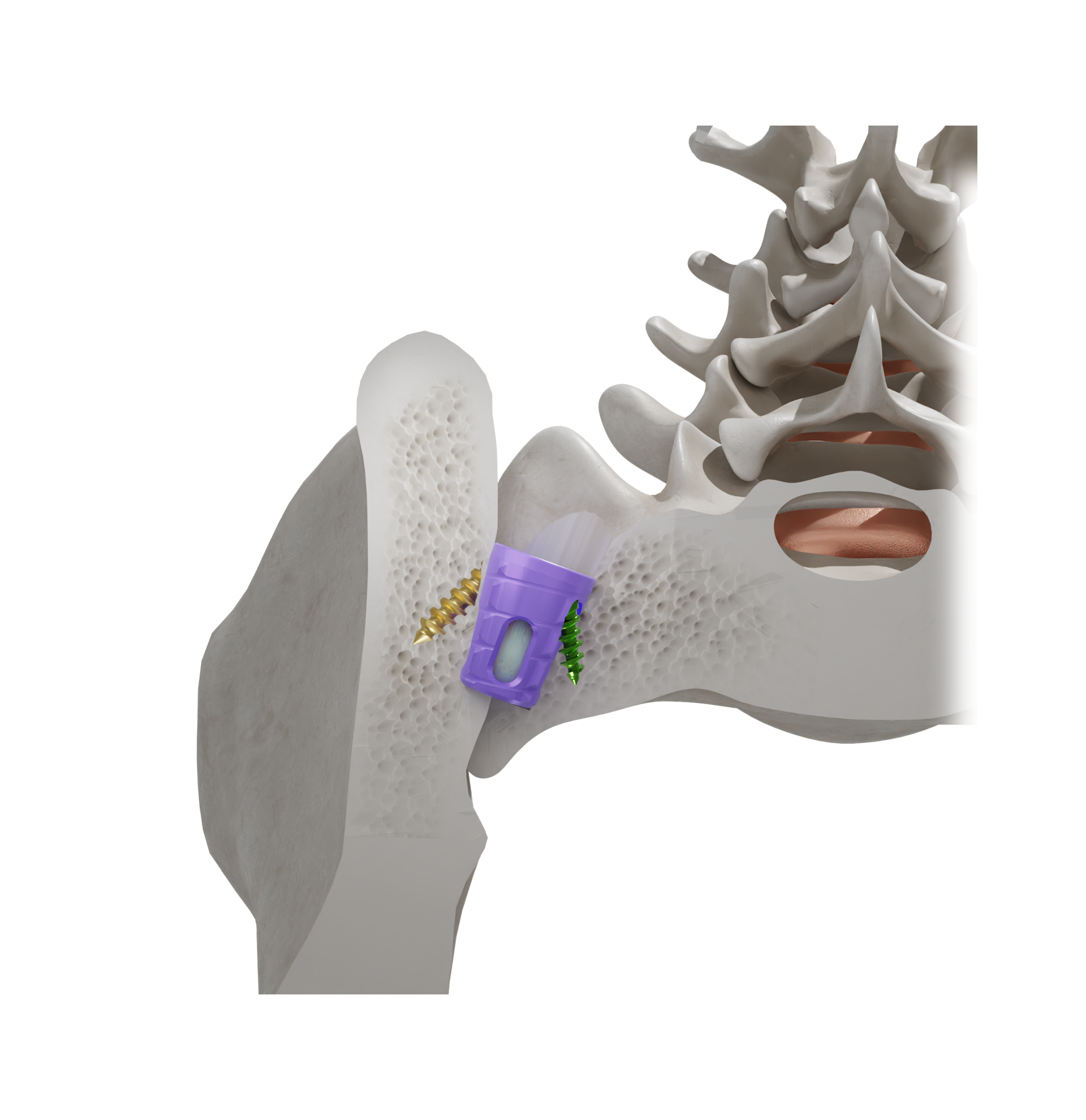 SiLO TFX SI joint anatomy Cutaway illustration of the SiLO TFX system spanning the sacrum and ilium