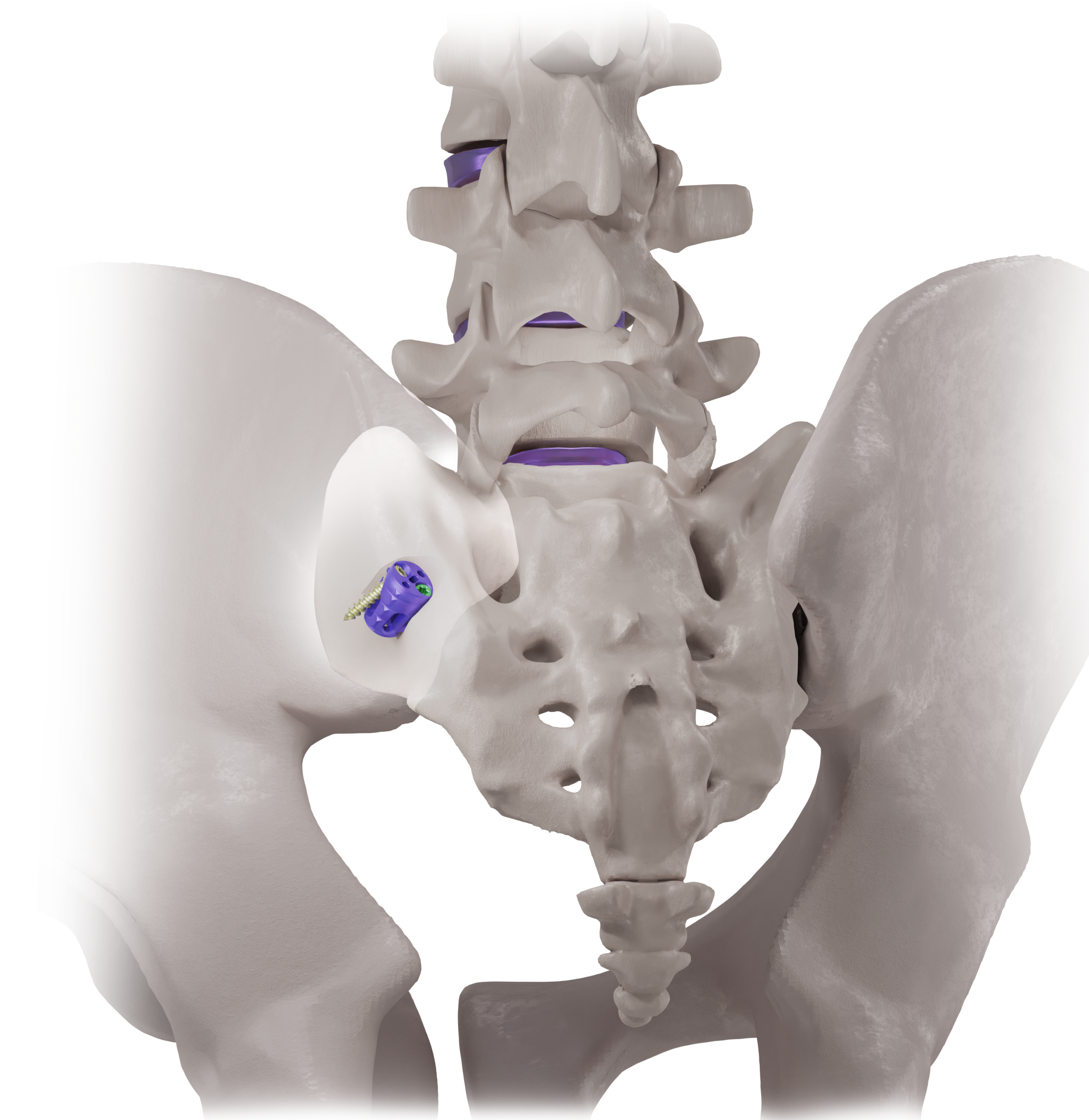 Aurora SiLO TFX SI joint illustration Pelvis showing the SiLO TFX implant at the sacroiliac joint