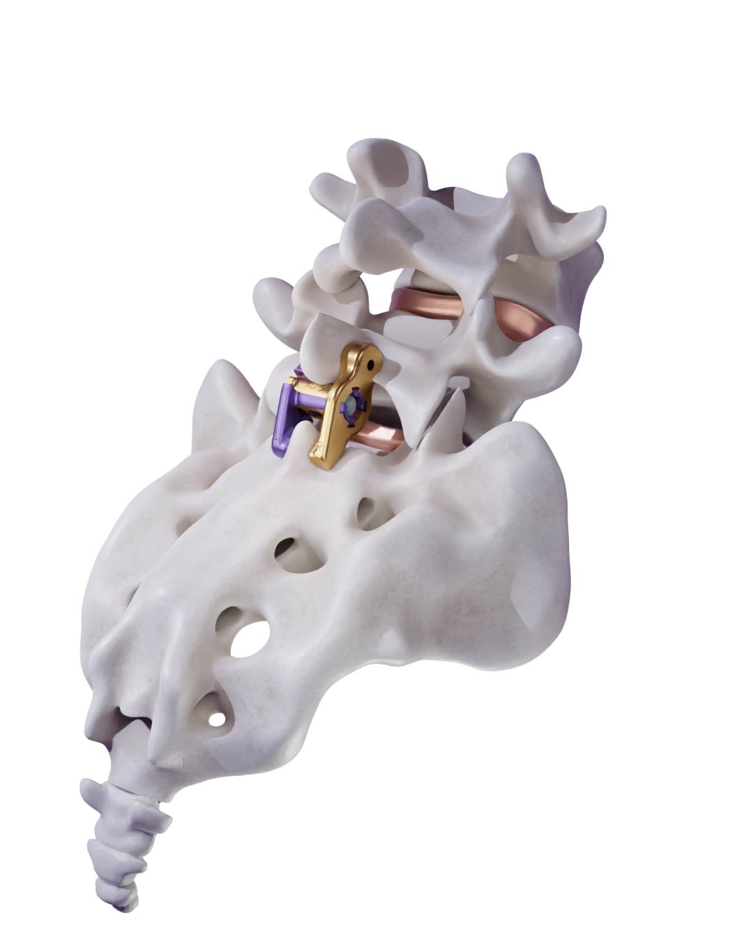 ZIP 51 lumbar implant illustration ZIP 51 implant designed for L5-S1 fusion