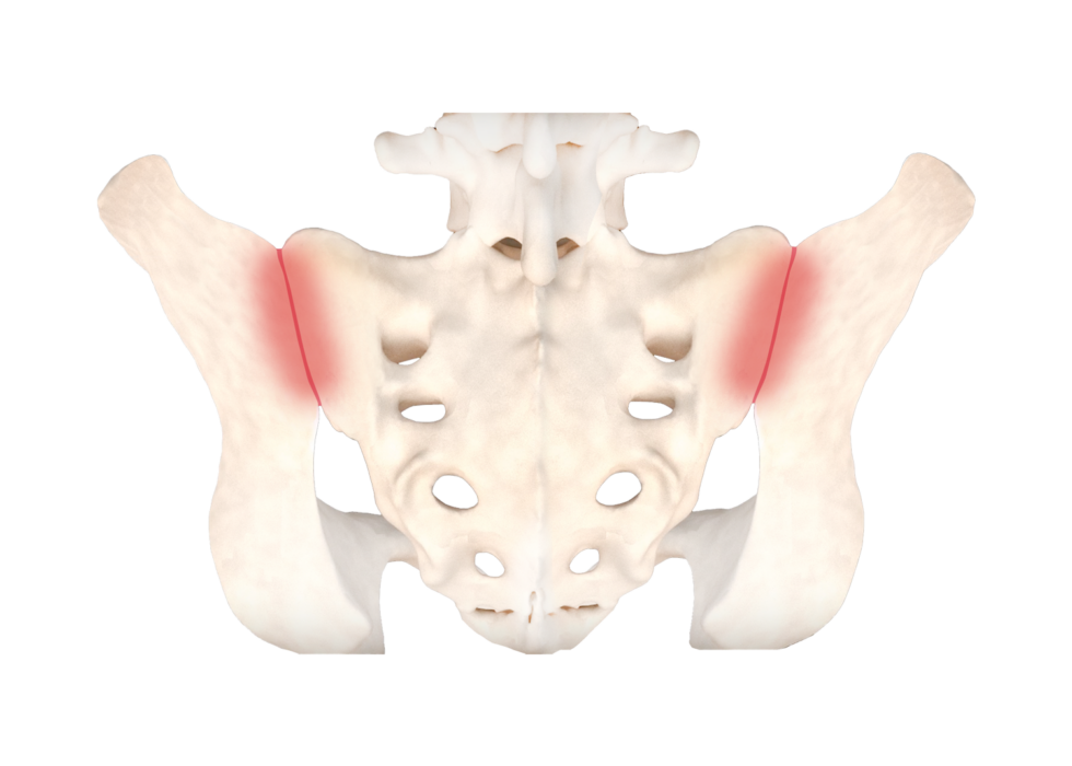 Inflamed sacroiliac joint illustration Illustration of an inflamed sacroiliac joint