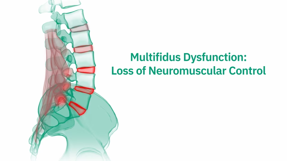ReActiv8 system illustration Illustration of multifidus dysfunction