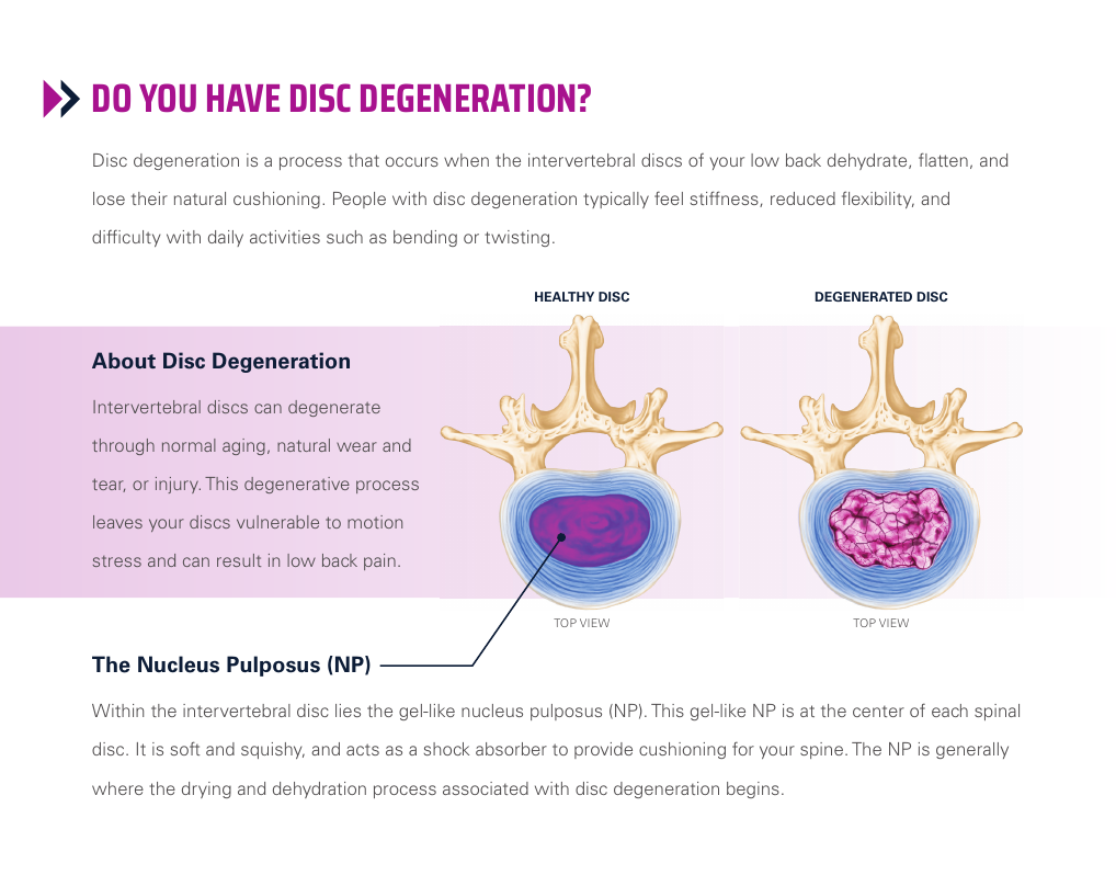Healthy and degenerated disc illustration Illustration comparing a healthy intervertebral disc with a degenerated disc