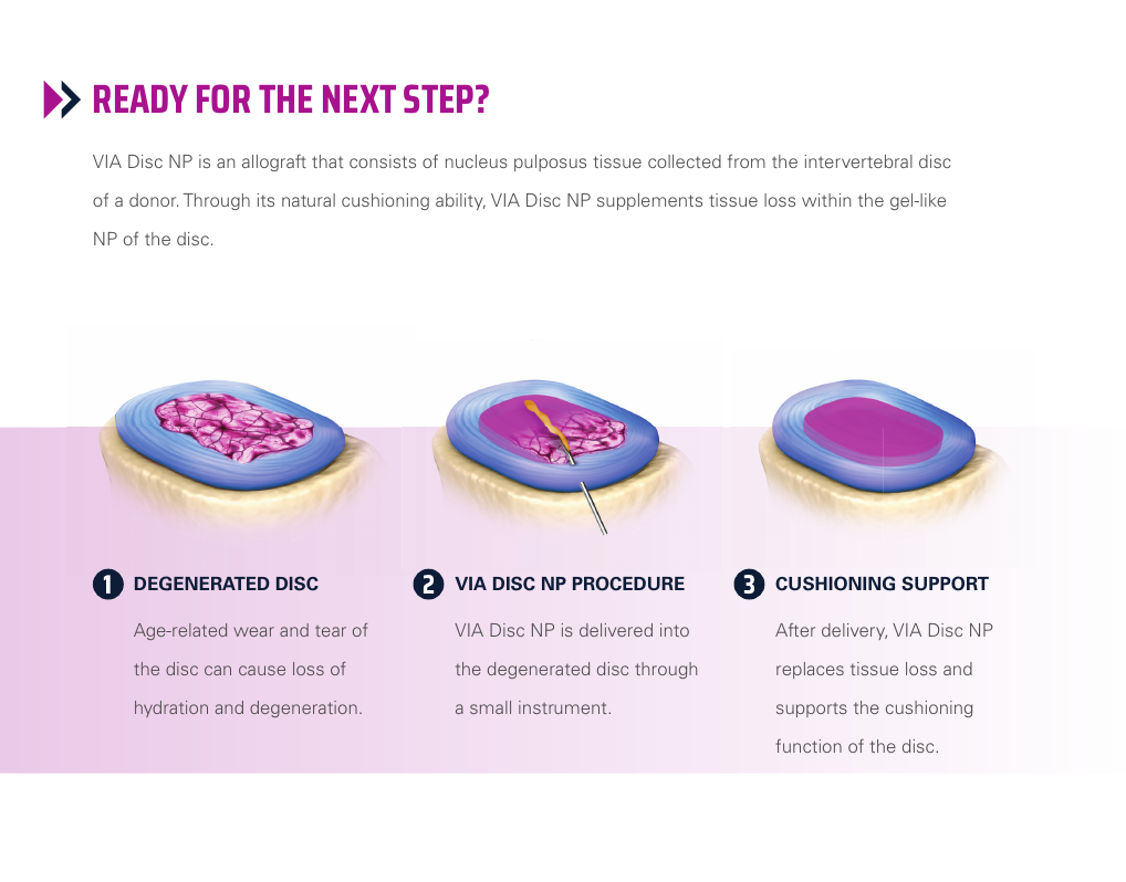 VIA Disc NP procedure illustration Three-step illustration showing a degenerated disc, VIA Disc NP delivery, and cushioning support